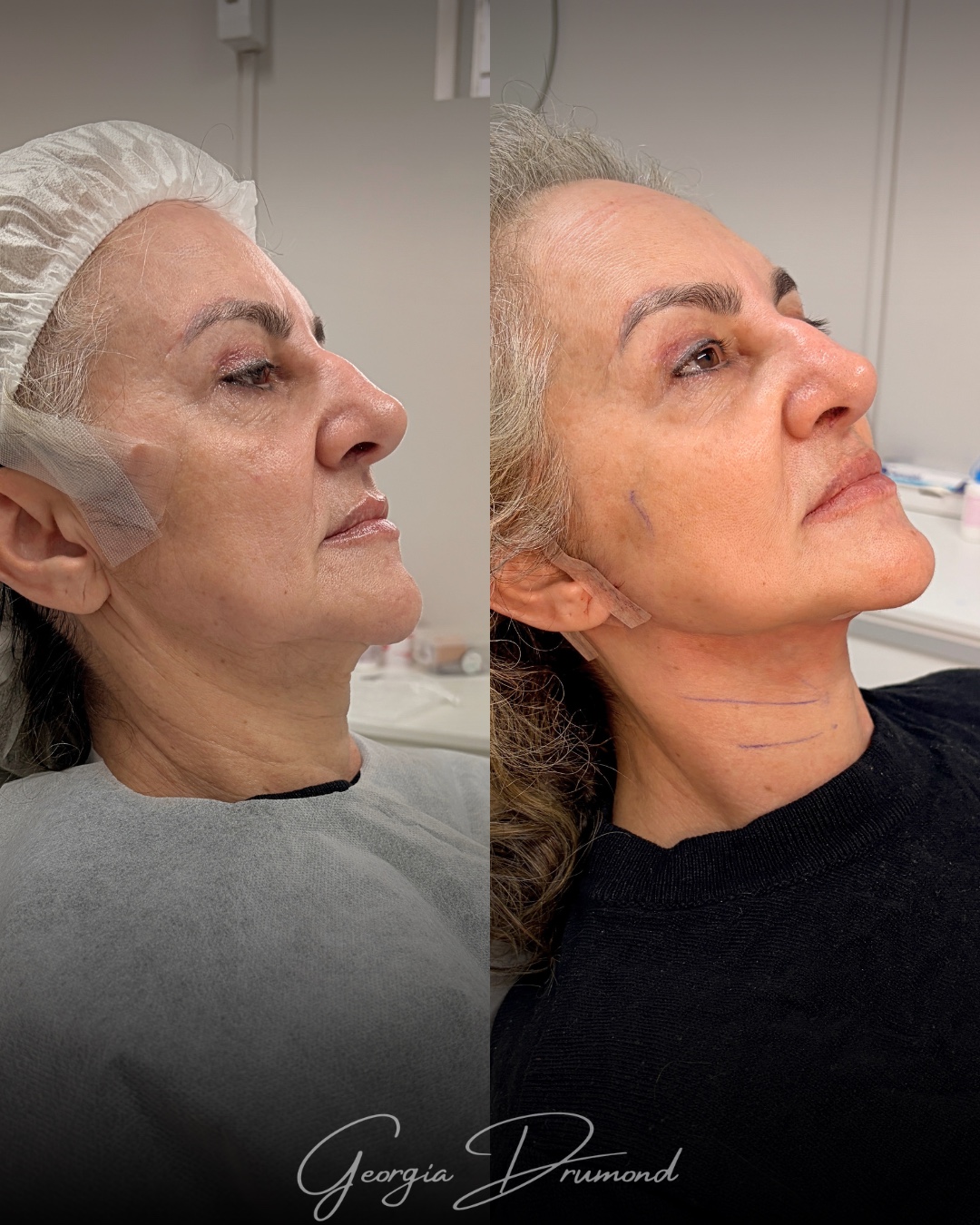 Caso clínico 02 com comparação antes e depois em ângulo oblíquo