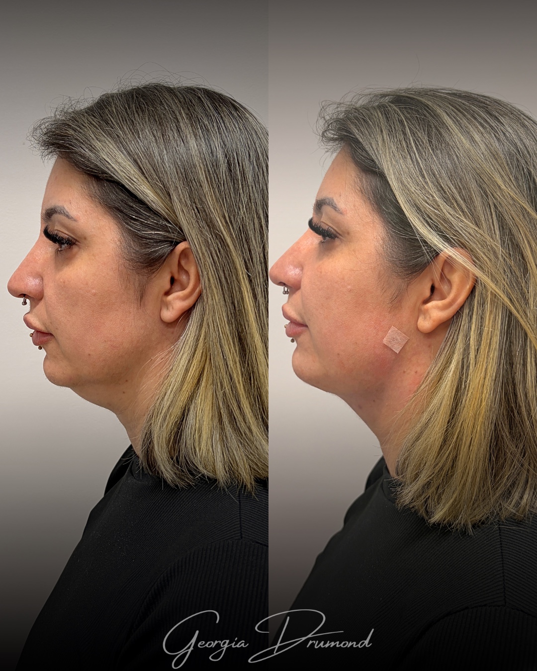 Caso clínico 03 de lipo de papada com comparação de perfil