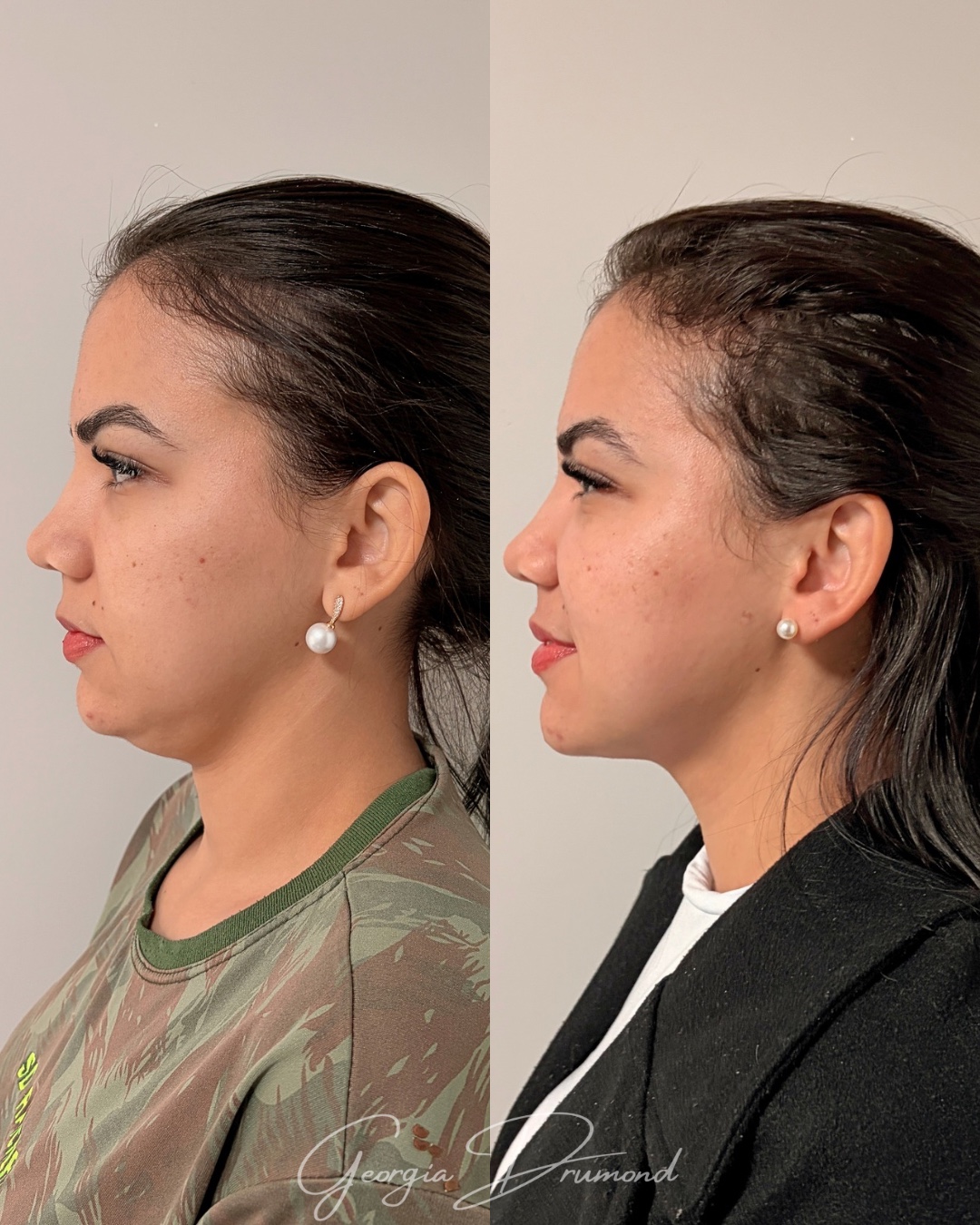 Caso clínico 07 com comparação antes e depois do perfil